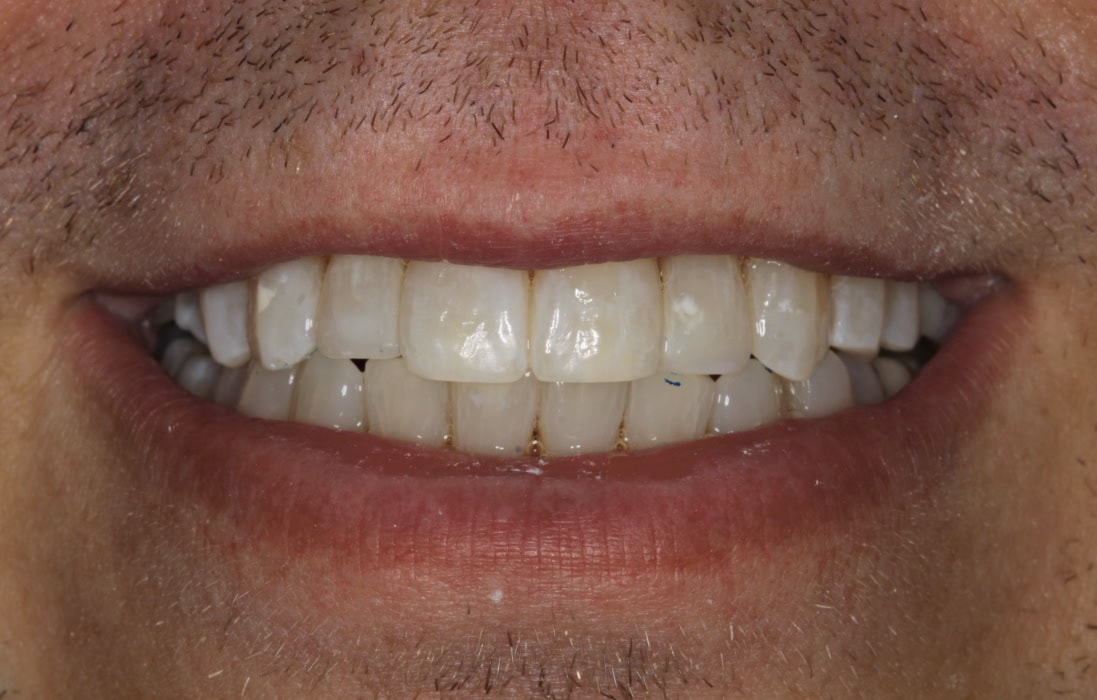 Smil efter alignerbehandling
