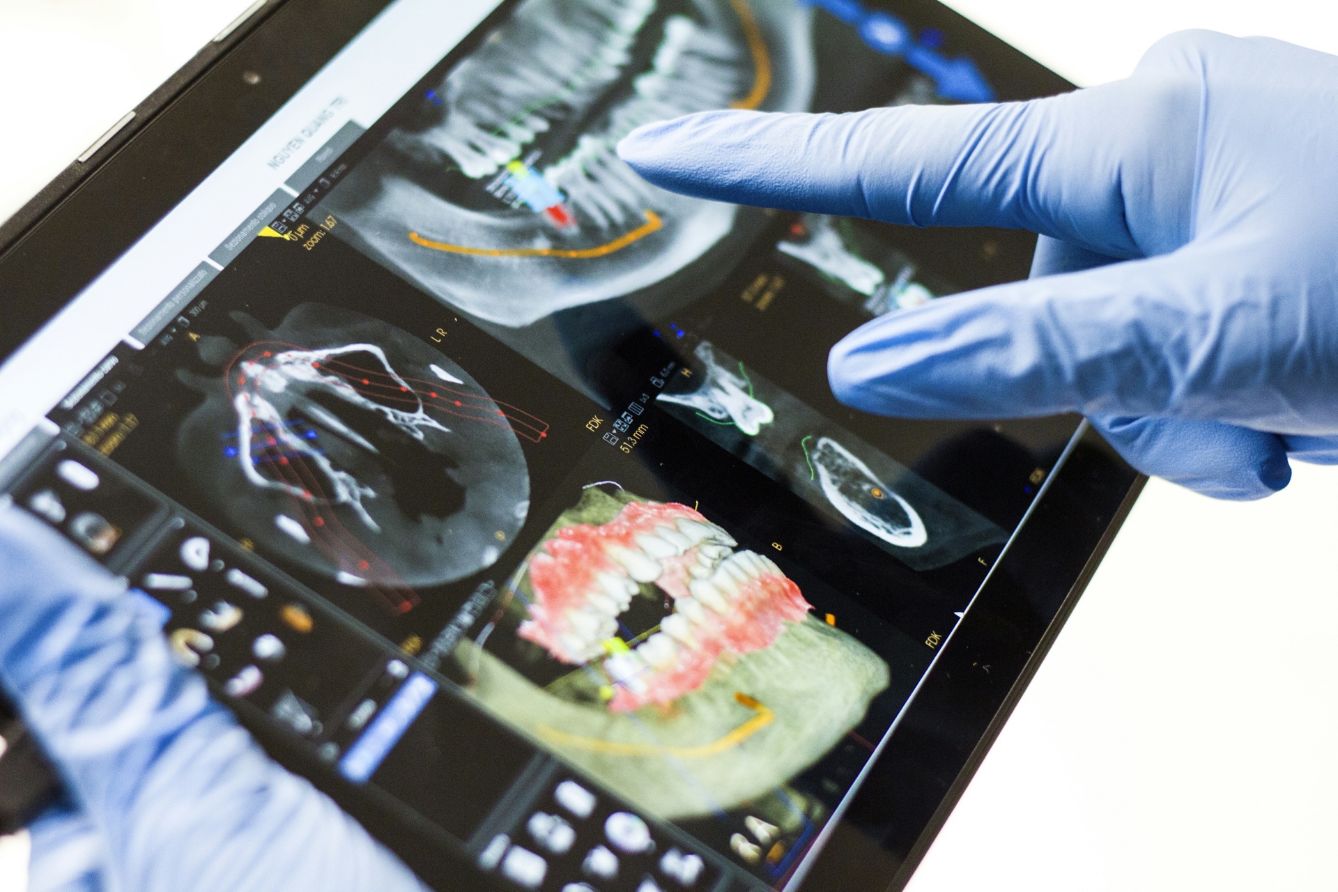 Blå handsker peger på digitale tandscanninger på en tablet.